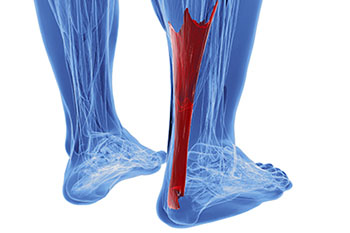 Achilles tendon treatment in the Fairport Harbor, OH 44077, Perry, OH 44081, Solon, OH 44139, Pepper Pike, OH 44124, Kirtland, OH 44094, Willoughby Hills, OH 44094, Highland Heights, OH 44143, Mayfield Village, OH 44143, South Euclid, OH 44121, Oakwood, OH 44146, Shaker Heights, OH 44120 areas