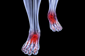 Arthritic foot care in the Fairport Harbor, OH 44077, Perry, OH 44081, Solon, OH 44139, Pepper Pike, OH 44124, Kirtland, OH 44094, Willoughby Hills, OH 44094, Highland Heights, OH 44143, Mayfield Village, OH 44143, South Euclid, OH 44121, Oakwood, OH 44146, Shaker Heights, OH 44120 areas