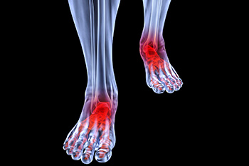 Arthritic foot care in the Fairport Harbor, OH 44077, Perry, OH 44081, Solon, OH 44139, Pepper Pike, OH 44124, Kirtland, OH 44094, Willoughby Hills, OH 44094, Highland Heights, OH 44143, Mayfield Village, OH 44143, South Euclid, OH 44121, Oakwood, OH 44146, Shaker Heights, OH 44120 areas