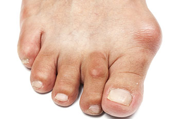 Bunions treatment in the Fairport Harbor, OH 44077, Perry, OH 44081, Solon, OH 44139, Pepper Pike, OH 44124, Kirtland, OH 44094, Willoughby Hills, OH 44094, Highland Heights, OH 44143, Mayfield Village, OH 44143, South Euclid, OH 44121, Oakwood, OH 44146, Shaker Heights, OH 44120 areas