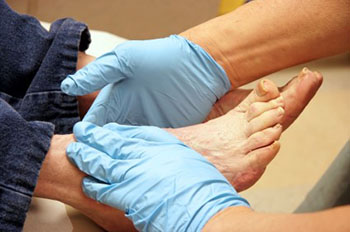 Diabetic foot treatment in the Fairport Harbor, OH 44077, Perry, OH 44081, Solon, OH 44139, Pepper Pike, OH 44124, Kirtland, OH 44094, Willoughby Hills, OH 44094, Highland Heights, OH 44143, Mayfield Village, OH 44143, South Euclid, OH 44121, Oakwood, OH 44146, Shaker Heights, OH 44120 areas