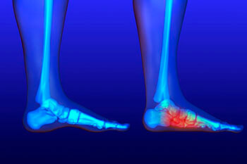 Flat feet treatment in the Fairport Harbor, OH 44077, Perry, OH 44081, Solon, OH 44139, Pepper Pike, OH 44124, Kirtland, OH 44094, Willoughby Hills, OH 44094, Highland Heights, OH 44143, Mayfield Village, OH 44143, South Euclid, OH 44121, Oakwood, OH 44146, Shaker Heights, OH 44120 areas