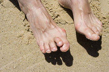Hammertoe treatment in the Fairport Harbor, OH 44077, Perry, OH 44081, Solon, OH 44139, Pepper Pike, OH 44124, Kirtland, OH 44094, Willoughby Hills, OH 44094, Highland Heights, OH 44143, Mayfield Village, OH 44143, South Euclid, OH 44121, Oakwood, OH 44146, Shaker Heights, OH 44120 areas