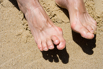 Hammertoe treatment in the Fairport Harbor, OH 44077, Perry, OH 44081, Solon, OH 44139, Pepper Pike, OH 44124, Kirtland, OH 44094, Willoughby Hills, OH 44094, Highland Heights, OH 44143, Mayfield Village, OH 44143, South Euclid, OH 44121, Oakwood, OH 44146, Shaker Heights, OH 44120 areas