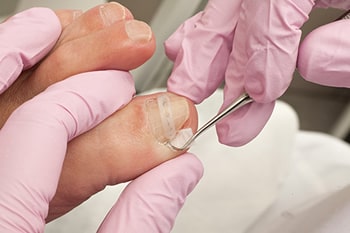 Ingrown toenail treatment in the Fairport Harbor, OH 44077, Perry, OH 44081, Solon, OH 44139, Pepper Pike, OH 44124, Kirtland, OH 44094, Willoughby Hills, OH 44094, Highland Heights, OH 44143, Mayfield Village, OH 44143, South Euclid, OH 44121, Oakwood, OH 44146, Shaker Heights, OH 44120 areas