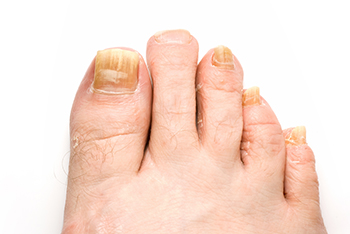 Toenail fungus treatment in the Fairport Harbor, OH 44077, Perry, OH 44081, Solon, OH 44139, Pepper Pike, OH 44124, Kirtland, OH 44094, Willoughby Hills, OH 44094, Highland Heights, OH 44143, Mayfield Village, OH 44143, South Euclid, OH 44121, Oakwood, OH 44146, Shaker Heights, OH 44120 areas