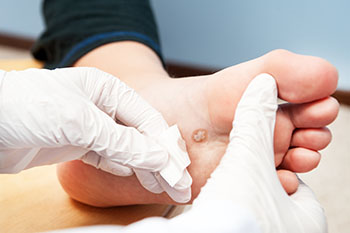 Warts treatment in the Lake County and Cuyahoga County, OH: Fairport Harbor, Perry, Solon, Pepper Pike, Kirtland, Willoughby Hills, Highland Heights, Mayfield Village, South Euclid, Oakwood, and Shaker Heights areas