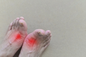 Living With Gout