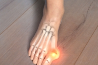 Exploring Outcomes of Bunion Surgery