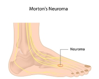 What Can Cause Morton’s Neuroma?