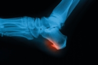 Podiatric Care for Heel Spurs