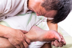 Treatments for Gout Attacks